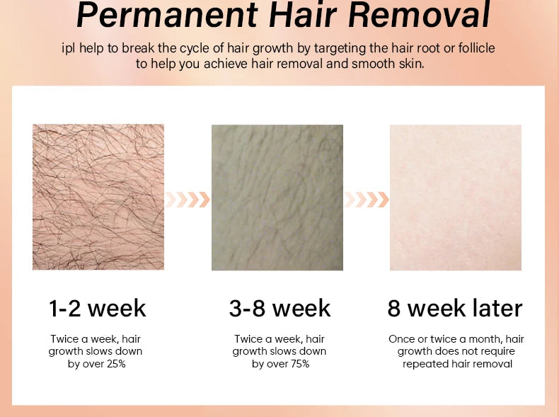 KODO 2026 High-End Personalisierung Eis Laser Haarentfernung Laser Epilierer Permanent IPL Schmerzloser Fotoepilierer 4 in 1 für Gesicht und Körper